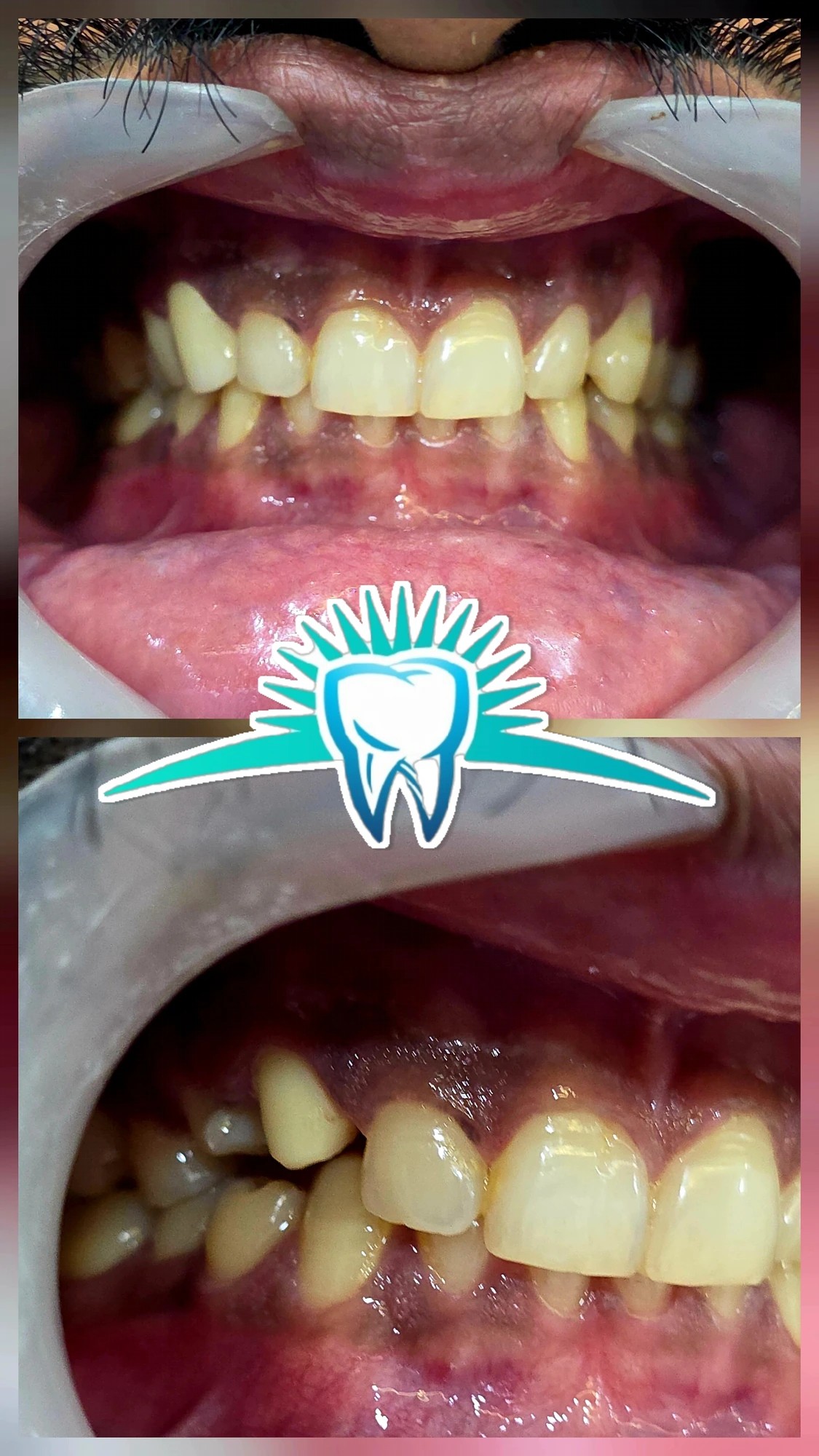 Crowded Teeth, Corrected