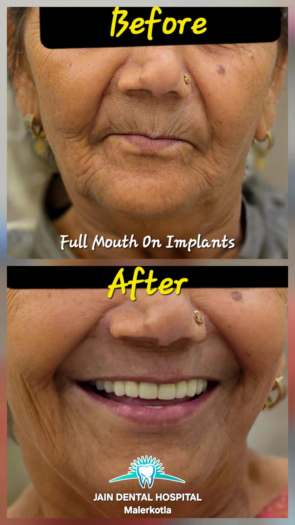 Full Mouth on Implants