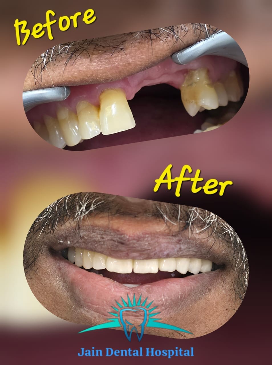 Missing Tooth, Fixed