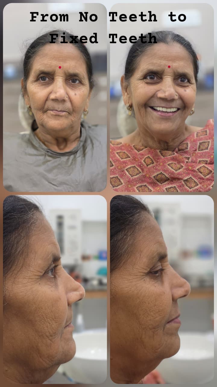 From No Teeth to Fixed Teeth